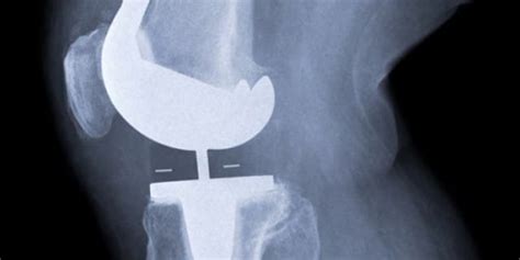 Types Of Knee Replacement | Types Of