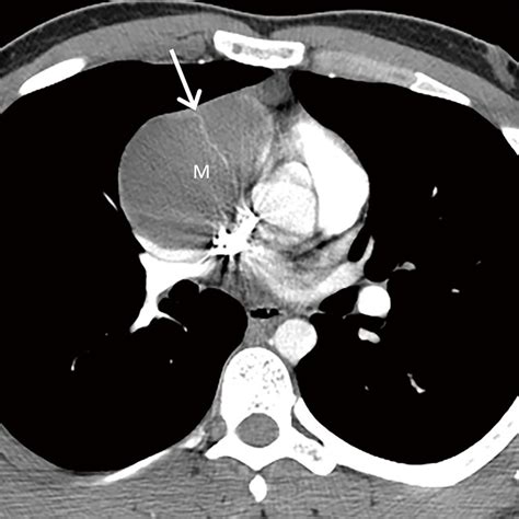 Diagnostic Approach To The Anterior Prevascular Mediastinum For