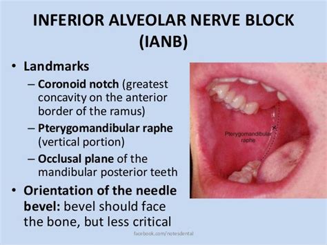 Inferior Alveolar Nerve Block Landmarks