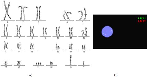 Genetics of Down Syndrome | IntechOpen