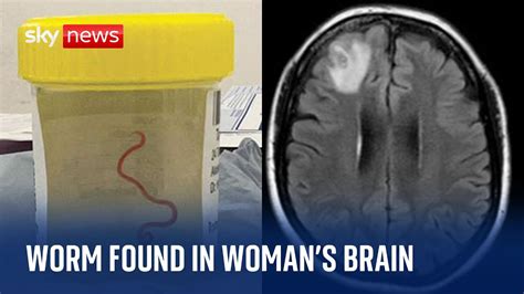 Live Worm Found In Woman S Brain In World First Discovery YouTube