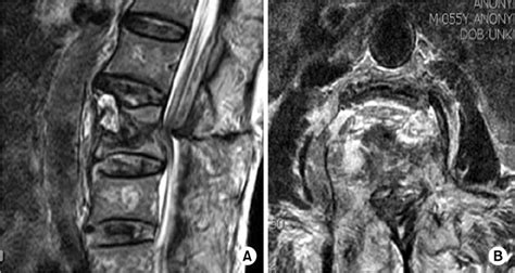 A B Preoperative T2 Weighted Sagittal And Axial Mri Show