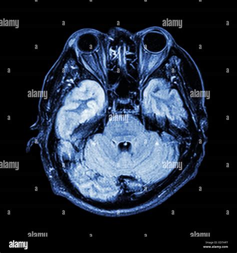 The cerebellum hi-res stock photography and images - Alamy