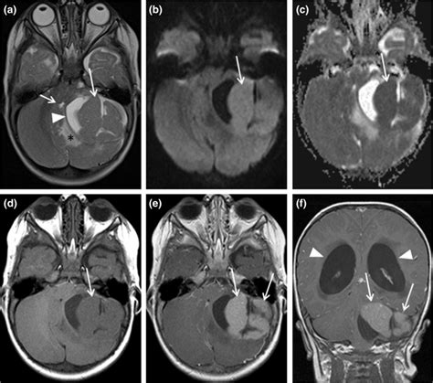 Brain MRI showing a tumor of the posterior fossa of a 14‐month‐old ...