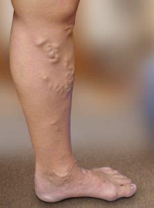 Vericose Veins Vein Conditions Triangle Vein Clinic Cary Nc