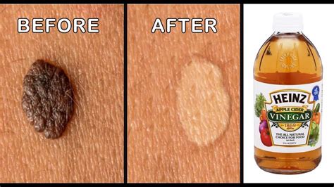 Mole removal by apple cider vinegar effective ways to remove skin tags ...