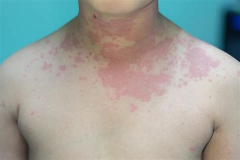 12 Common Skin Rashes In Children And Their Treatments