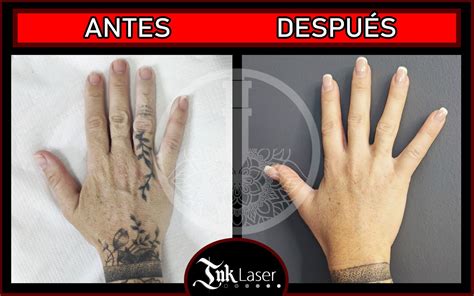 Resultados De Tatuajes Borrados Con L Ser Antes Y Despu S