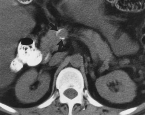 Calcification In The Veins