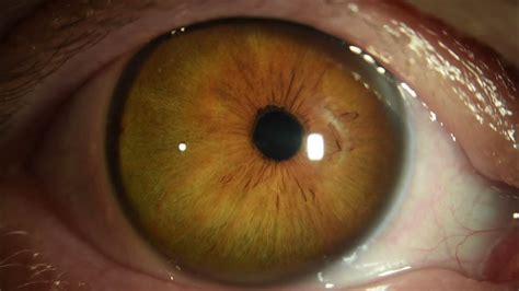 X-linked megalocornea with dislocated IOL - YouTube