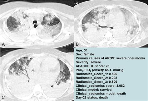 Chest CT Images Of A 31 Year Old Female Admitted To The Intensive Care