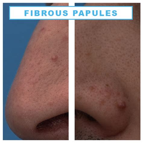 Fibrous Papule Fibrous Papule Of The Nose Fibrous Papule Treatment