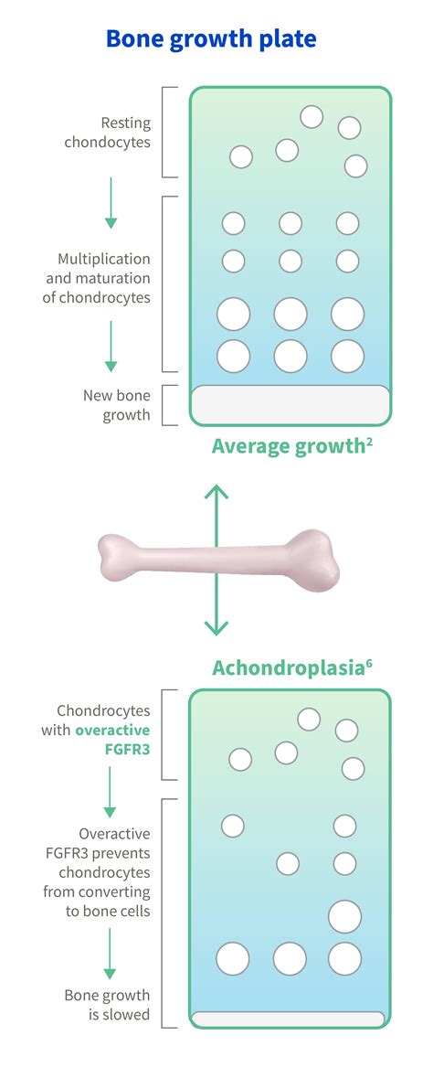 What Is Achondroplasia? | Causes & Impact On Life | QED Tx