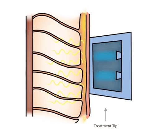 RF Skin Tightening Treatment - Dream Plastic Surgery