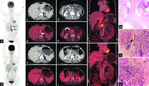 A Black Arrows Maximum Intensity Projection Mip Image Showing