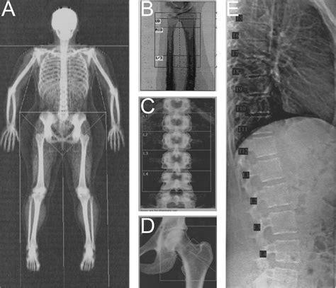 Sample DXA Images Bone Density Mass And Area Are Calculated For Each