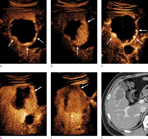 Figure 3 From The Principle Of Contrast Enhanced Ultrasound And The Diagnosis Of Hepatocellular