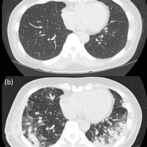 Bronchoscopy. (a) Transbronchial biopsy was performed through the left ...