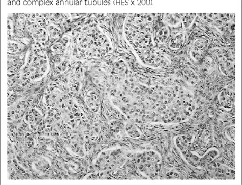 Colonic Adenocarcinoma And Bilateral Malignant Ovarian Sex Cord Tumor