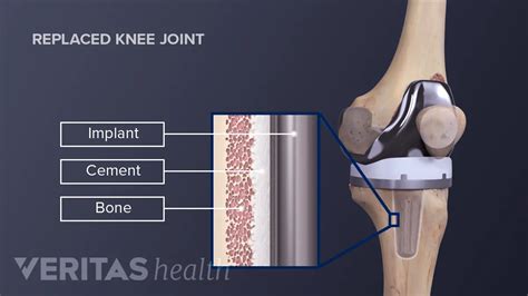 Knee Joint Replacement Devices