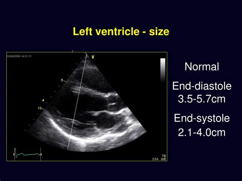 Ppt Basic Echocardiography Powerpoint Presentation Free Download