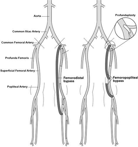 Surgical Intervention For Peripheral Arterial Disease Circulation Research