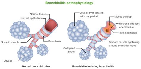 Bronchiolitis Obliterans | Concise Medical Knowledge