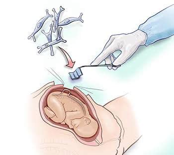 Spina Bifida Treatment MEDizzy