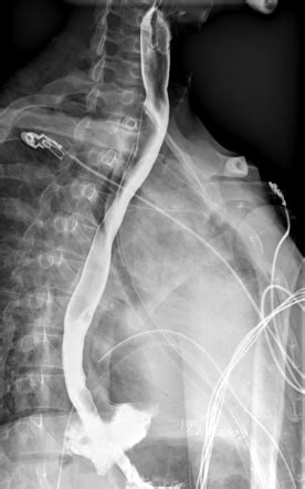 Esophageal Perforation With Large Hydropneumothorax Image