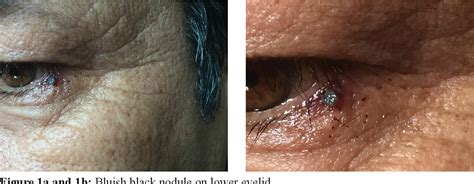 Figure 1 From Tick Infestation Masquerading As A Nodule In The Eye Lid