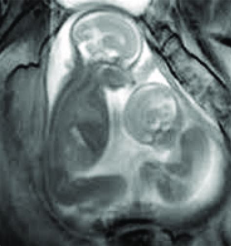 Example Based Mr Unborn Babies Medical Image State The View Of The Twin