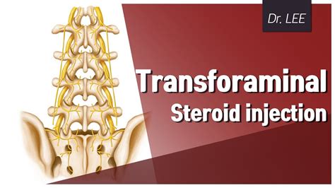 Technique Of L Transforaminal And L S Facet Joint Steroid Injection