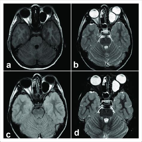 MRI Images In The T1 A T2 B FLAIR C And STIR D Sequences