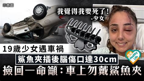 恐怖意外｜19歲女遇車禍 鯊魚夾插後腦傷口達30cm 撿回一命籲：車上勿戴鯊魚夾 晴報 健康 生活健康 D230321