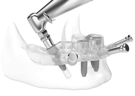 What is guided dental implant surgery? - Texas Implant & Dental Center ...