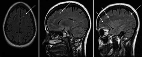 Brain Mri Shows White Spot