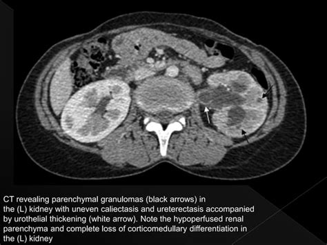 Renal tuberculosis radiology | PPT