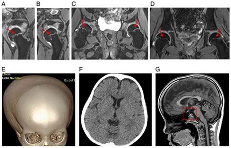 Further Phenotypic Features And Two Novel Poc1a Variants In A Patient