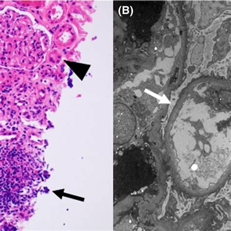 Renal Biopsy Finding A Light Microscopy Lm ×20 Tubules Reveal