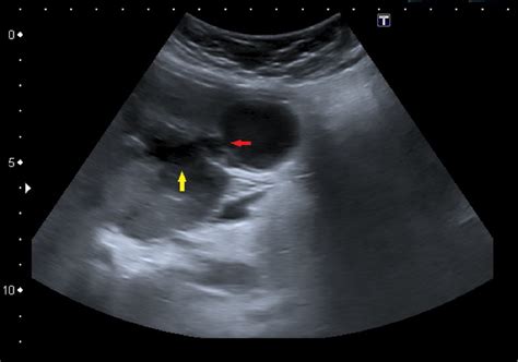 Figure 3 From Gallbladder Perforation Radiological Aspects Types And