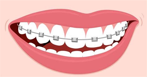 Brackets Dibujo Orto Dentistas Arganzuela Ortodoncia E Implantes