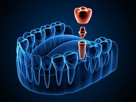 Dental Implant Kent Dentist Seablue Dental Of Kent