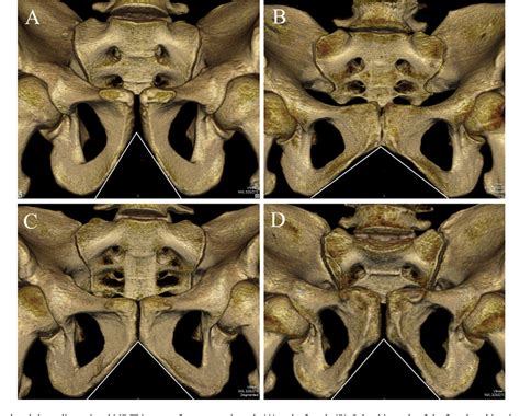 The Subpubic Angle In Sex Determination Anthropometric Measurements And Analyses On Anatolian
