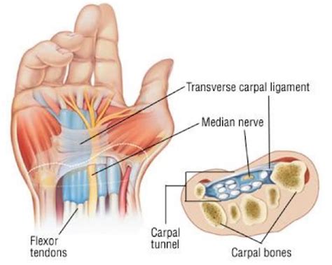 Carpal Tunnel Diagram - Ryde Natural Health Clinic