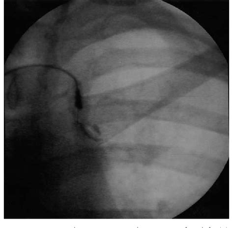 Figure 1 from Pain referral from the sternoclavicular joint: a study in ...