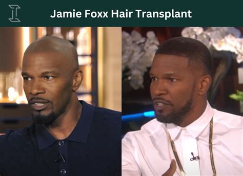 Famous Actors With Hair Transplant 20 Before And After Photos