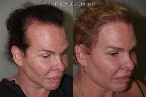 Hair Transplants For Women Special Cases Photos Miami Fl Patient41900