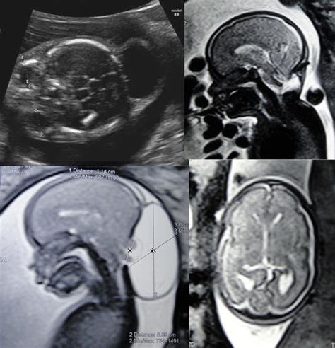 Illustrative Case Of A Fetus That Presented Occipital Encephalocele And