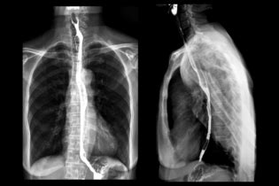 Barium Swallow - radiologystar