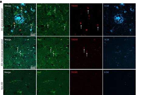 Research Links Age Related Inflammation Microglia And Alzheimer S Disease